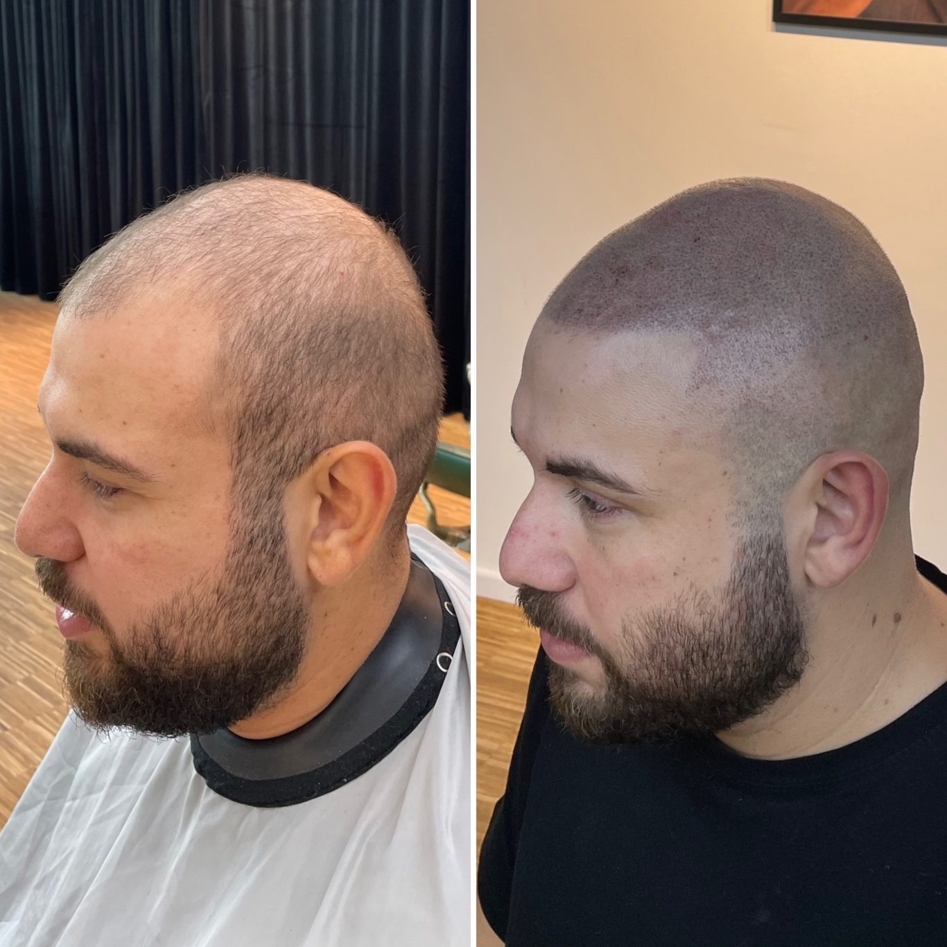 Vor und Nach Scalp Micropigmentation Vorher/Nachher Bild