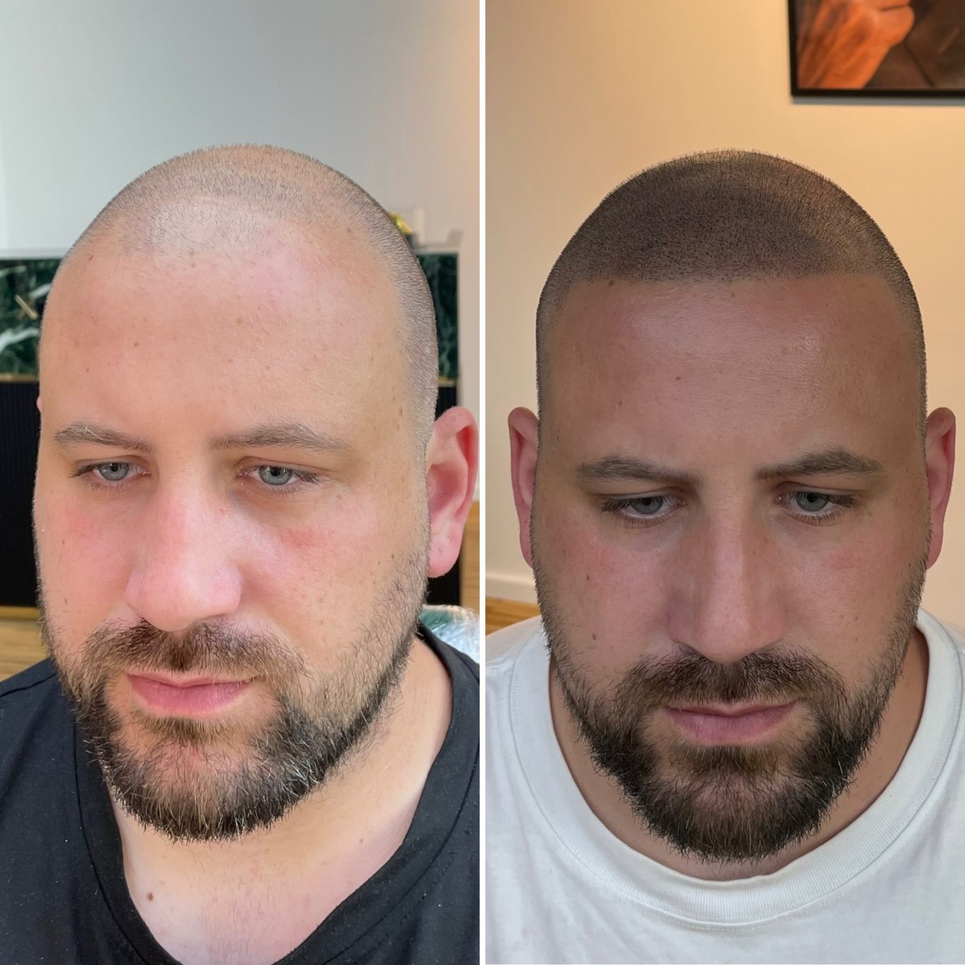 Scalp Micropigmentation am Kunden Vorher/Nachher Bild