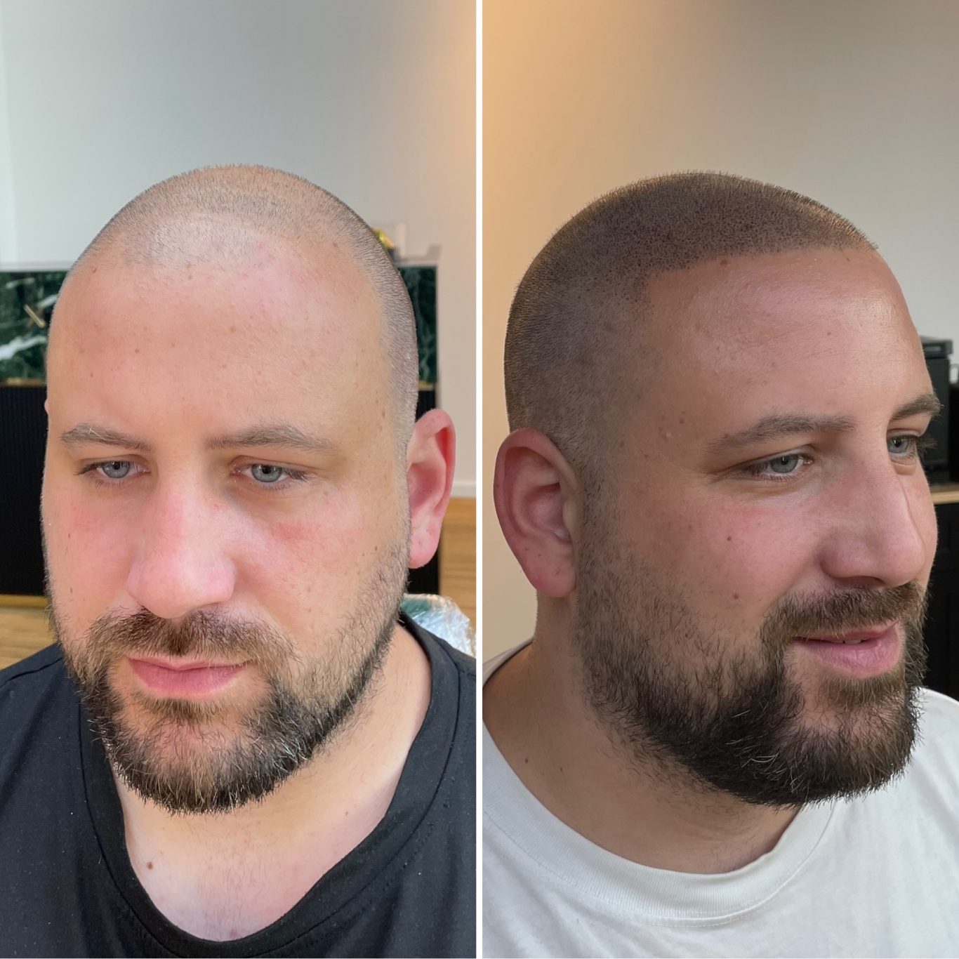 Vor und nach Scalp Micropigmentation Vorher/Nachher Bild.